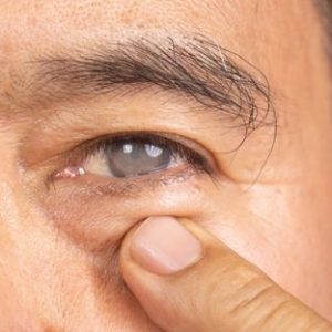 Essential Care Tips After Cataract Surgery