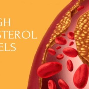 Be careful about these signs of high cholesterol that will be seen in the legs!!