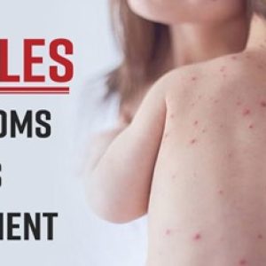 Be careful!! Know about these scary health issues that can affect you after you get measles!!