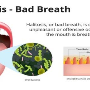 Having Halitosis or Bad breath problem? – These can be the important reasons!!