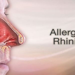 How pollution is making the allergic rhinitis problem in us to turn worse?