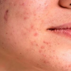 Various important reasons for getting chin acne, ways to manage etc!!