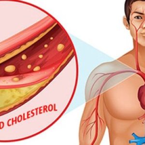 Swapping these foods with healthy foods would lower cholesterol levels and improve heart health!!