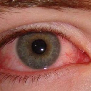 Madras Eye Prevention in Summer: Symptoms, Causes, and Safety Recommendations