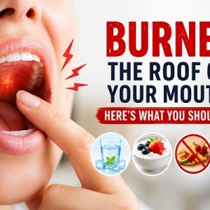 Burned the Roof of Your Mouth? Here’s What You Should Do
