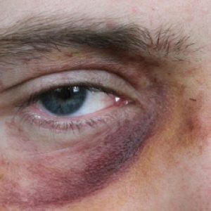 How high levels of uric acid in us could harm our eyesight or vision?