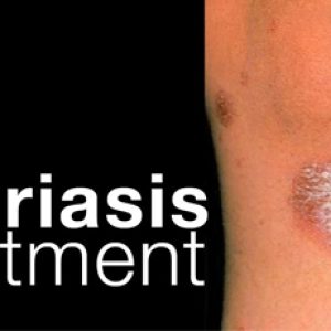 These essential oils can help us to manage psoriasis issue effectively!!